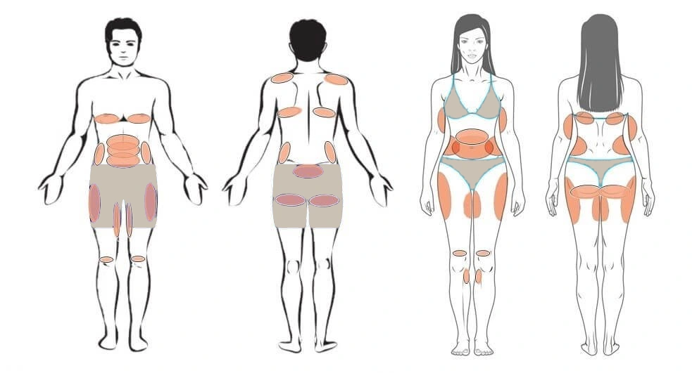 Zone del corpo trattabili con la criolipolisi